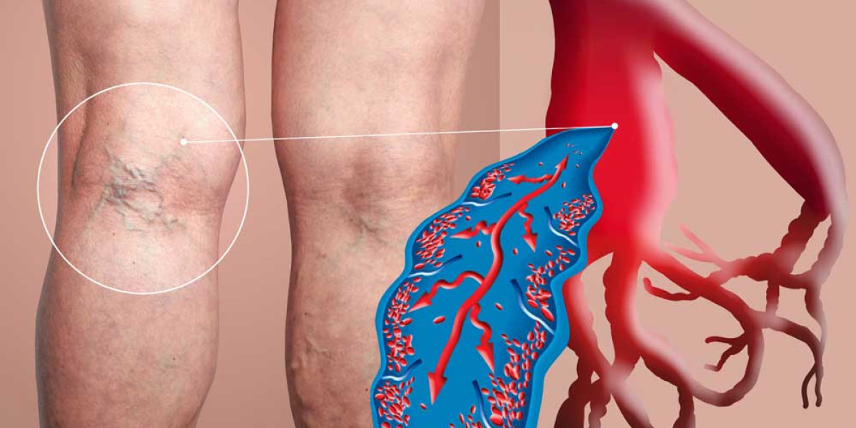 Rising Prevalence of Venous Disorders Boosts Demand for Varicose Veins Treatment Solutions