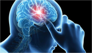 Best Homeopathic Doctor & Treatment for Migraine in India