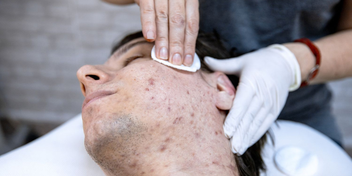 Acne Treatment Market Application Development, Competitive Market & Forecast 2023-2033