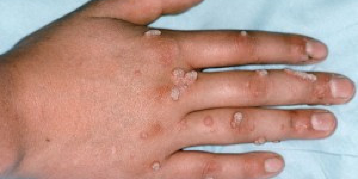 Genital Warts: Understanding Symptoms and Treatment in Islamabad