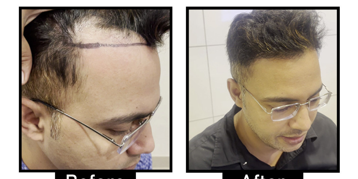 Comprehensive Guide to the Best Hair Loss Treatment in Delhi