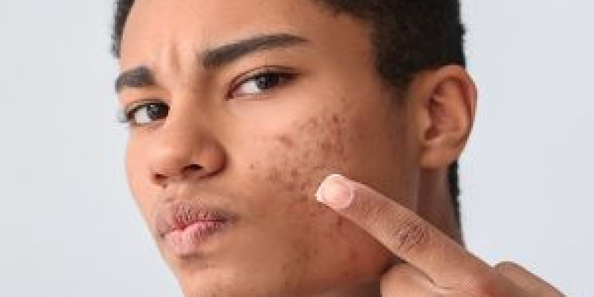 Affordable Acne Treatment Options in Islamabad