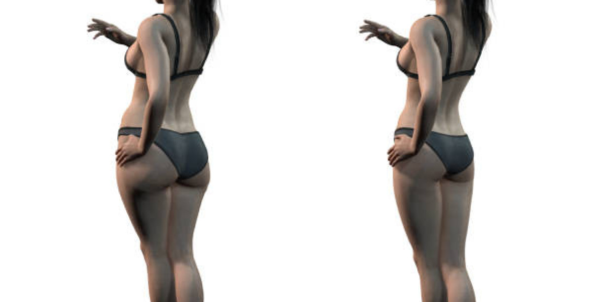 Brazilian Butt Lift Surgery: Transform Your Curves with BBL Utah