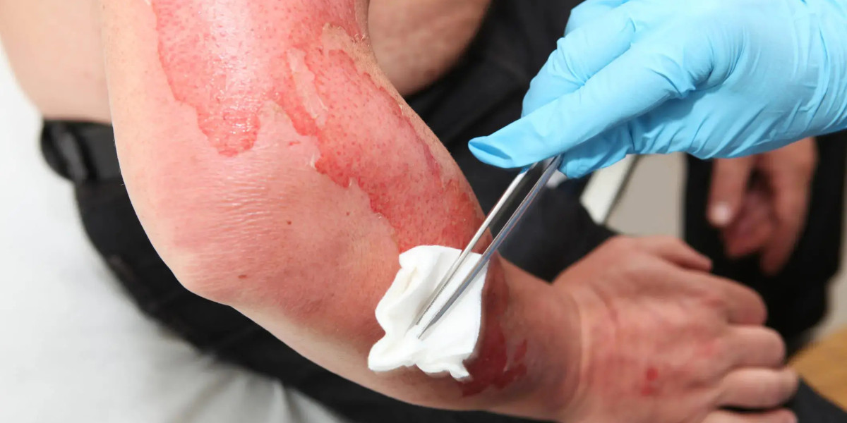 Burn Care Market Size, Industry Analysis Report 2023-2032 Globally