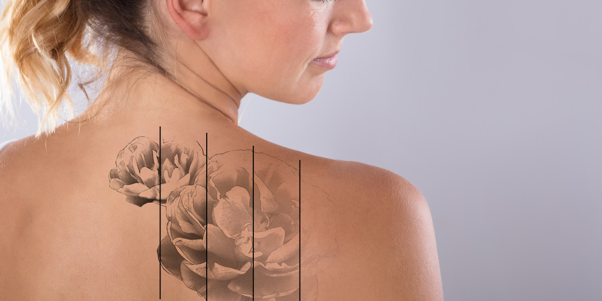 Laser Tattoo Removal Costs in Islamabad: What You Should Expect