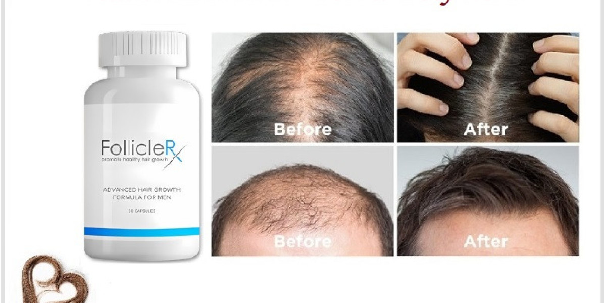 Follicle RX 리뷰: 이 탈모 솔루션이 정말 효과가 있을까요?