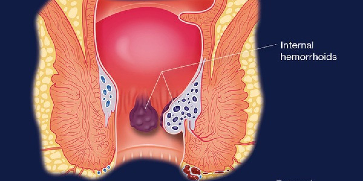 Hemorrhoids Market Size, Share, Trends, Industry Report 2024-34