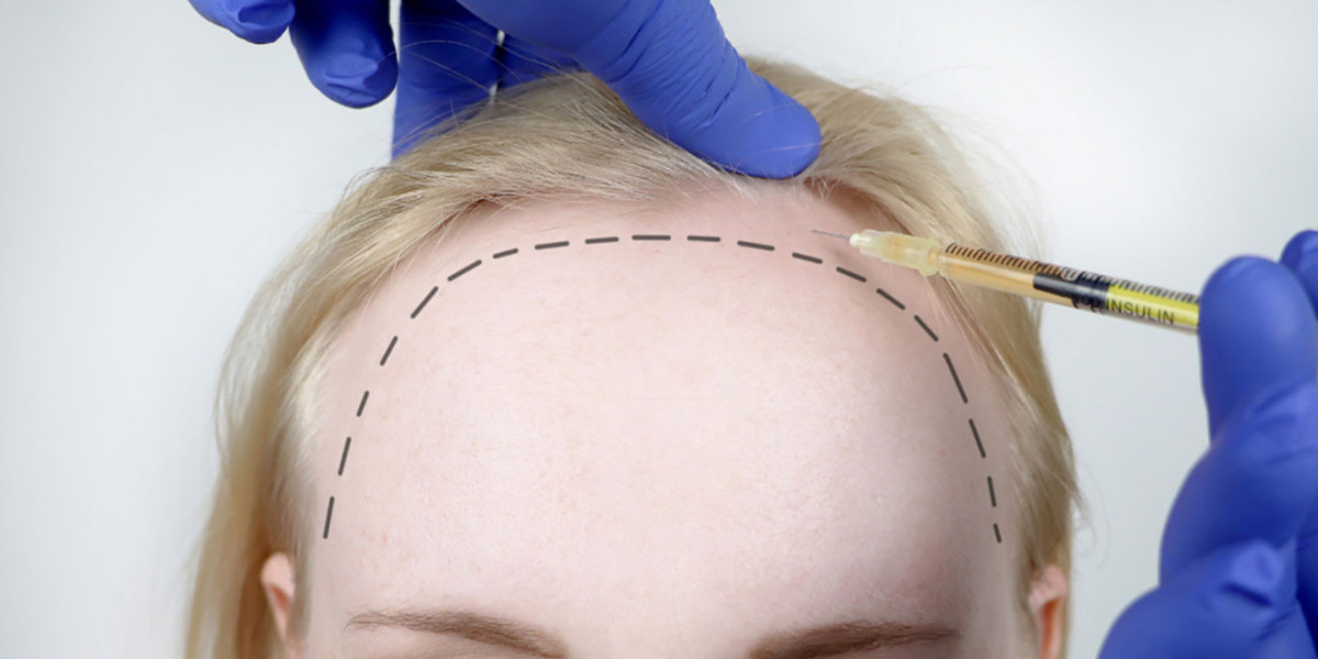 women hair transplant in bangalore