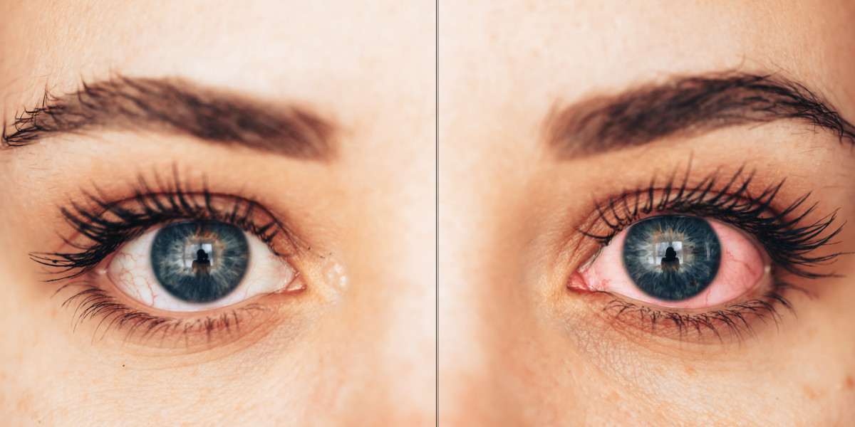 Research Report on the Autoimmune Uveitis Industry