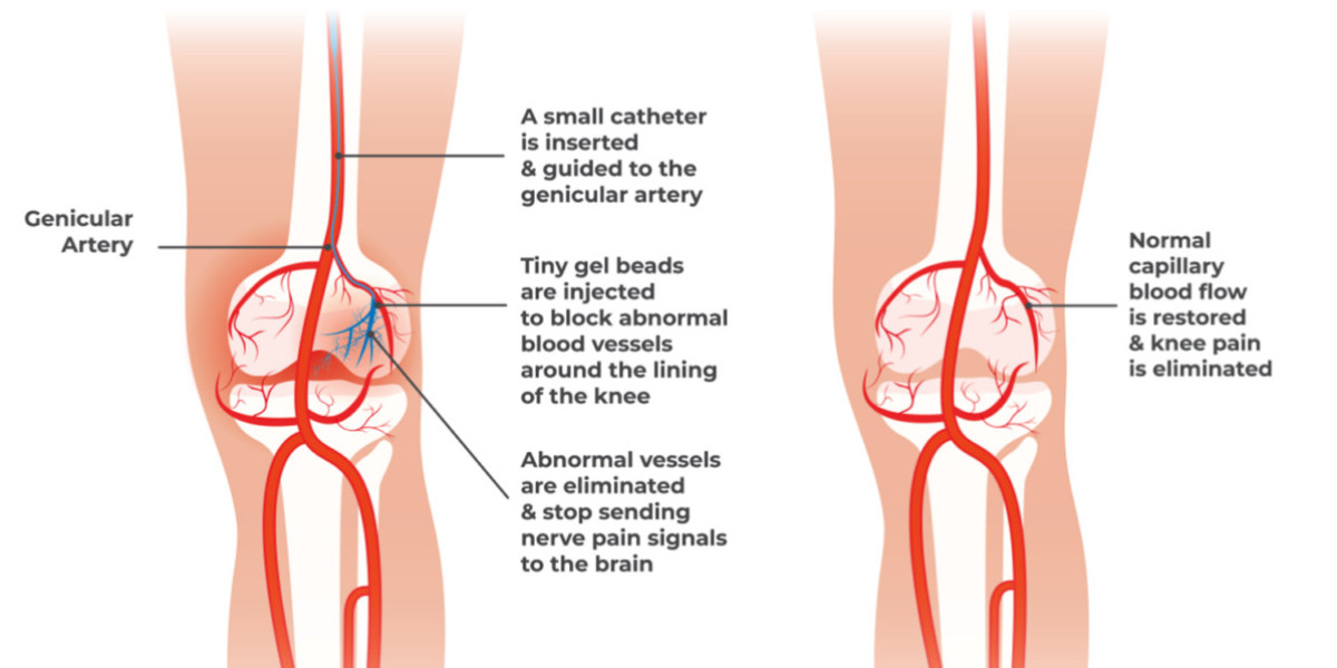 Understanding Genicular Artery Embolization: A Minimally Invasive Solution for Knee Pain | Flowcare