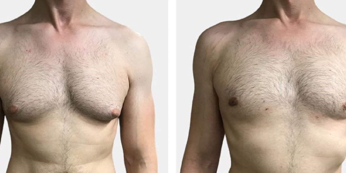 How the Best Gynecomastia Surgeons in Dubai Prioritize Patient Safety