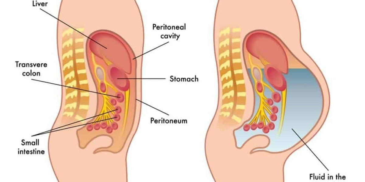 Ascites Market Overview, Industry Growth Rate, Research Report 2024-2034