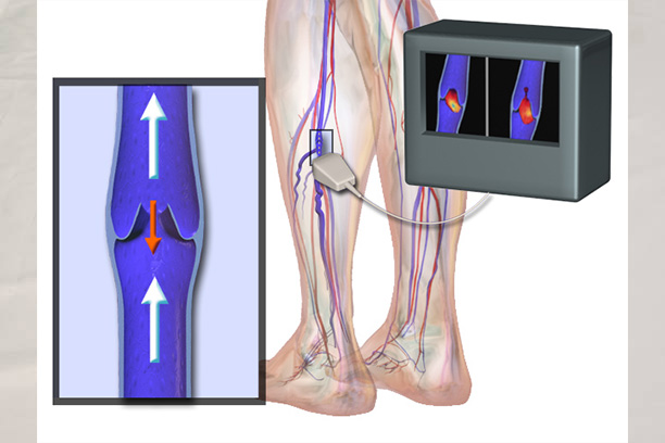 Advanced Varicose Vein Surgery Treatment by Dr. Premkumar at Chennai Diabetic Foot Care Centre | Ph: 9840525242 | Chennai Diabetic Foot Care | Dr. Premkumar, Podiatrist | A Foot Specialty Clinic