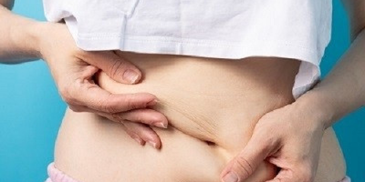 Liposuction in Islamabad: Procedure, Costs, and Benefits