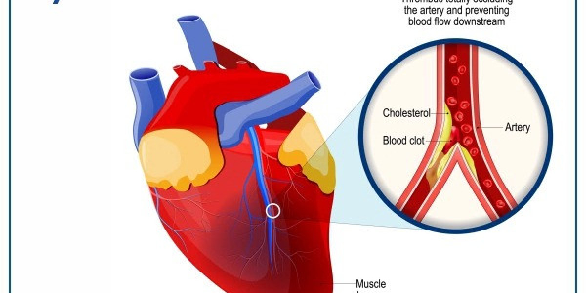 Myocardial Infarction Market Share Analysis, Growth, Report 2024-34
