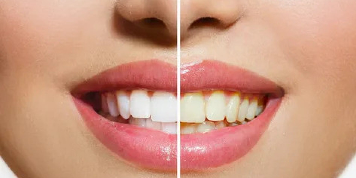 Achieve a Radiant Smile with the Best Tooth Whitening and Dental Implants in NYC