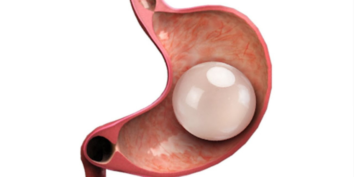 Intragastric Balloon Market: A Growing Solution for Weight Management