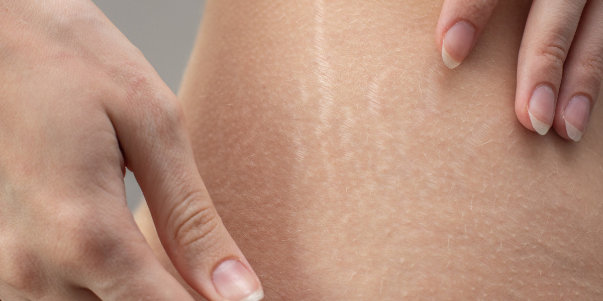 Stretch Mark Treatment Market: A Growing Opportunity