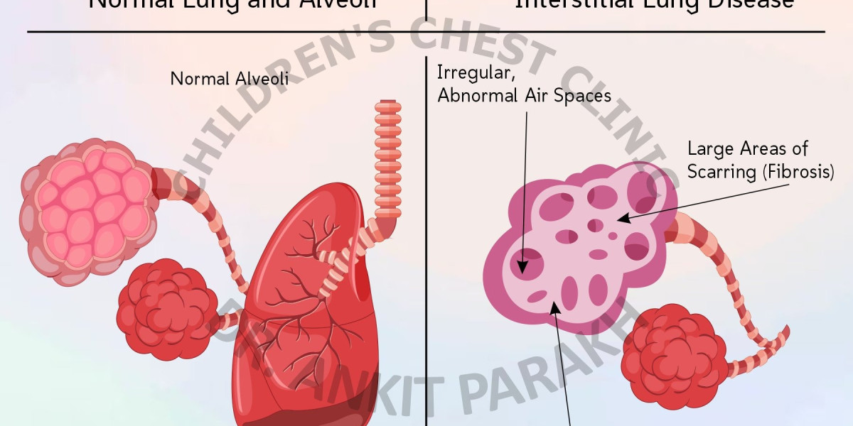 Interstitial Lung Disease Market Growth Analysis, Trends, Report 2024-34