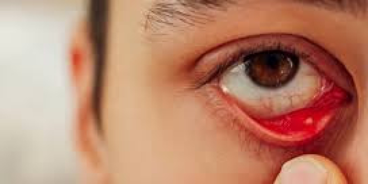 The Future of Giant Papillary Conjunctivitis Treatment: Market Size, Trends, and Forecasts to 2030