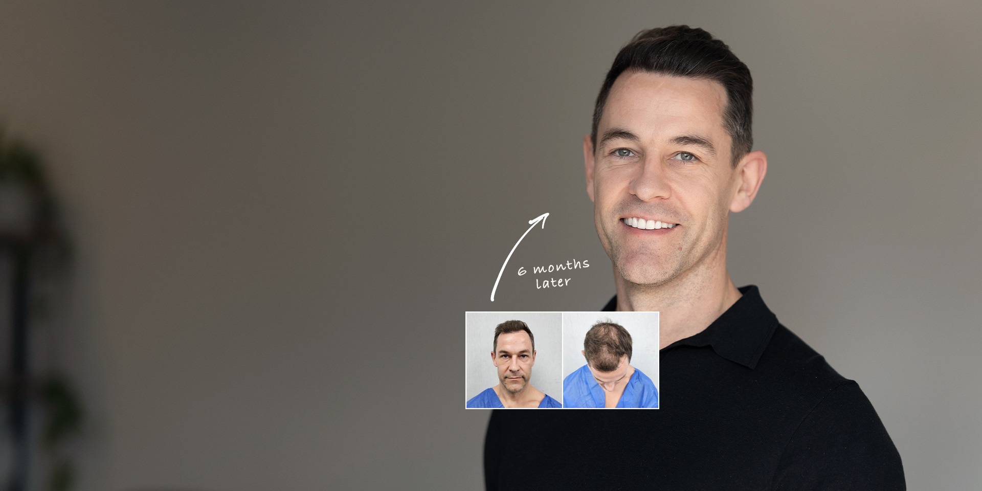 Best Hair Transplant in Brisbane | Hairline Clinic Brisbane