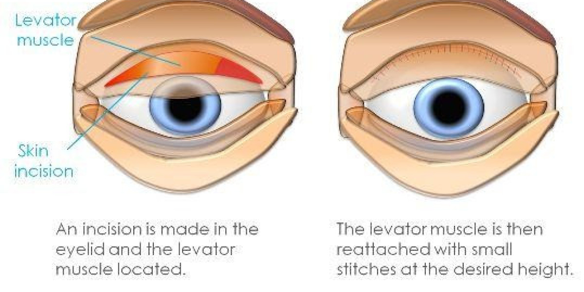 Ptosis Market Size, Analysis, Industry Statistics and Latest Insights Till 2034