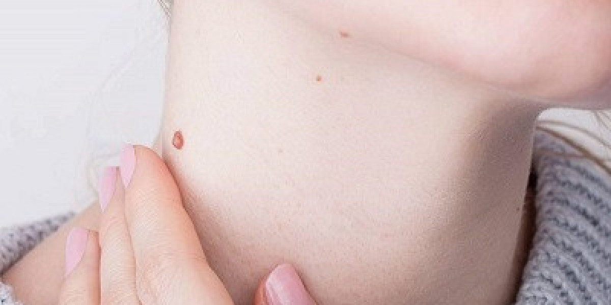 How to Prepare for a Mole Removal Consultation