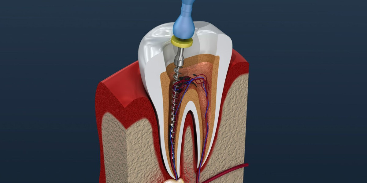 Burs and Endodontic Files Market - Overview