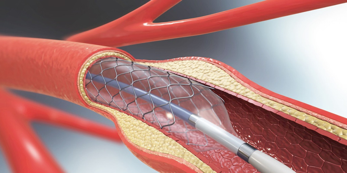 Angioplasty Balloons Market Key Growth Segments and Product Differentiation Trends