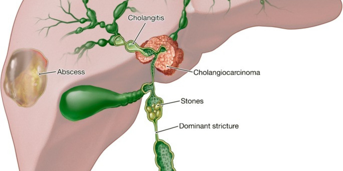 Primary Sclerosing Cholangitis Market Share, Industry Size, Growth, Forecast 2024-34