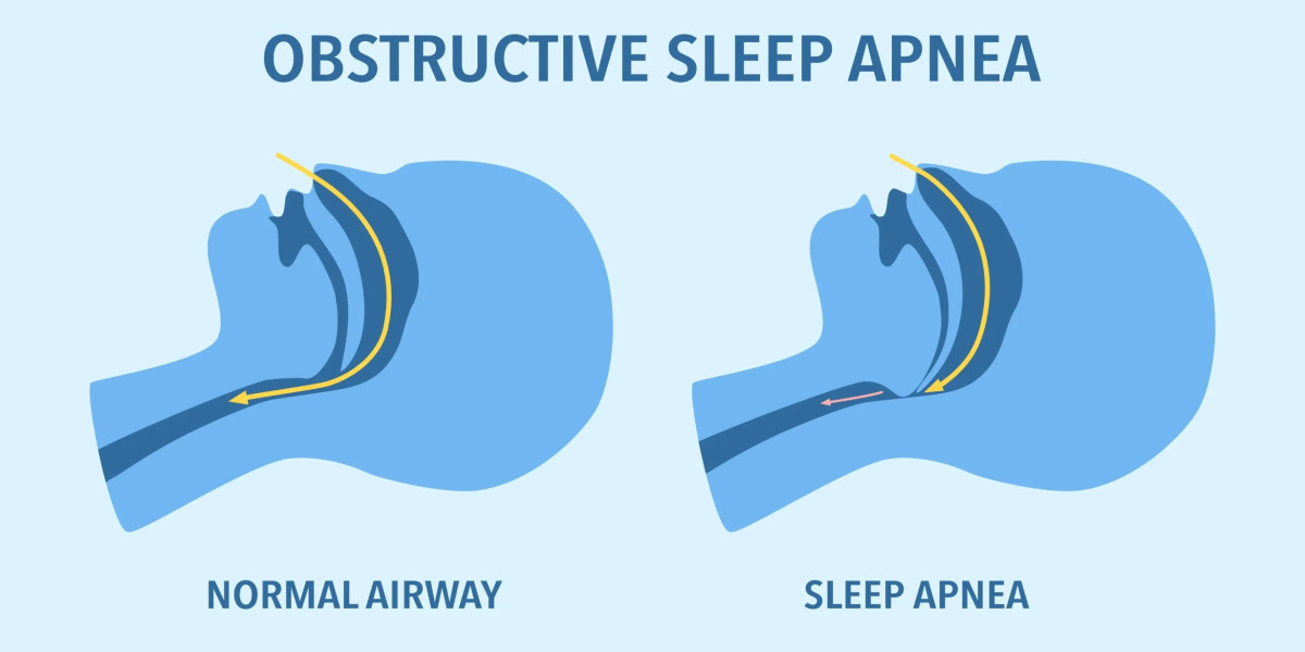 Obstructive Sleep Apnea Market Size, Share, Growth, Forecast 2024-34