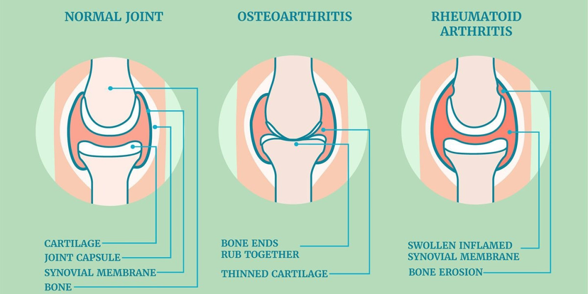 Rheumatoid Arthritis Market Demands, Growth Analysis, Industry Report 2024-2034