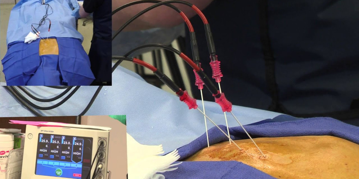 Radiofrequency Ablation Devices Market Players Density: Understanding Its Impact on Business Dynamics