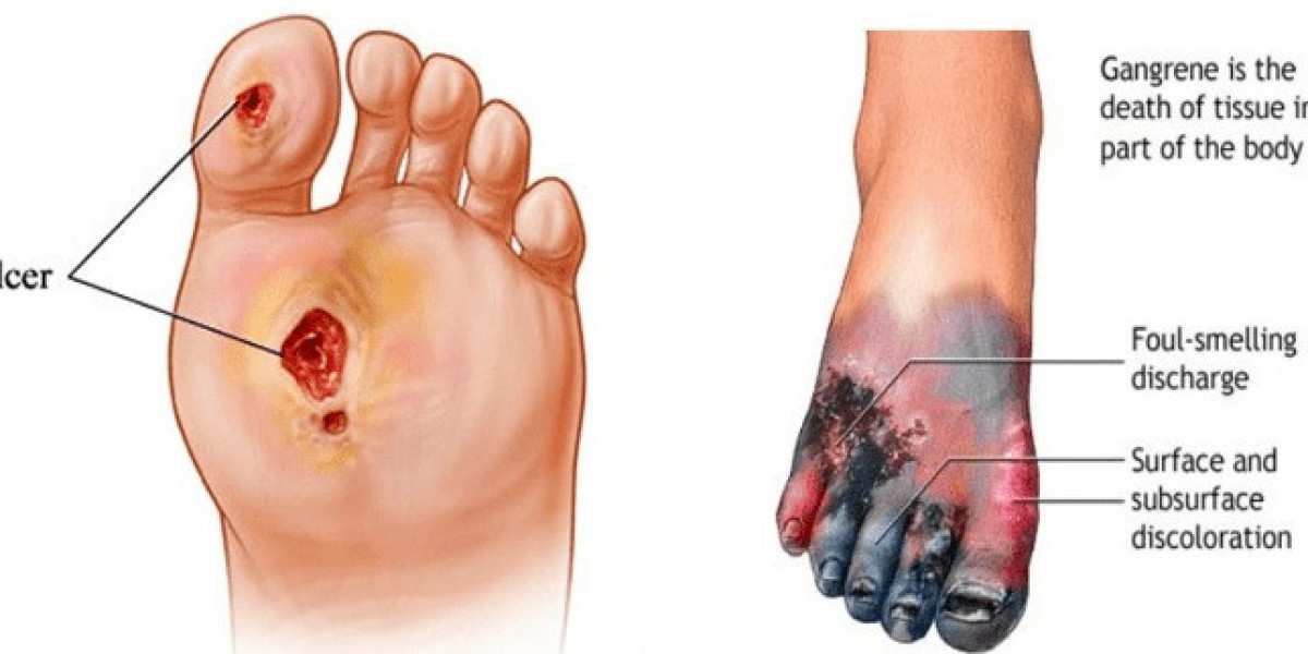 Critical Limb Ischemia Market Trends Analysis, Size, Share, Report 2024-34