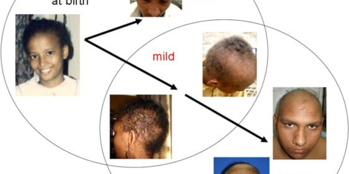 Hypotrichosis Market Demands, Growth Analysis, Industry Report 2024-2034