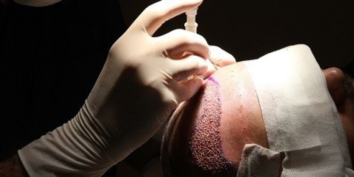 Safe and Effective Hair Transplants in Islamabad