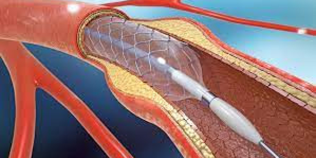 Angioplasty Balloons Market Growth Fueled By Key Market Drivers Across The Healthcare Industry