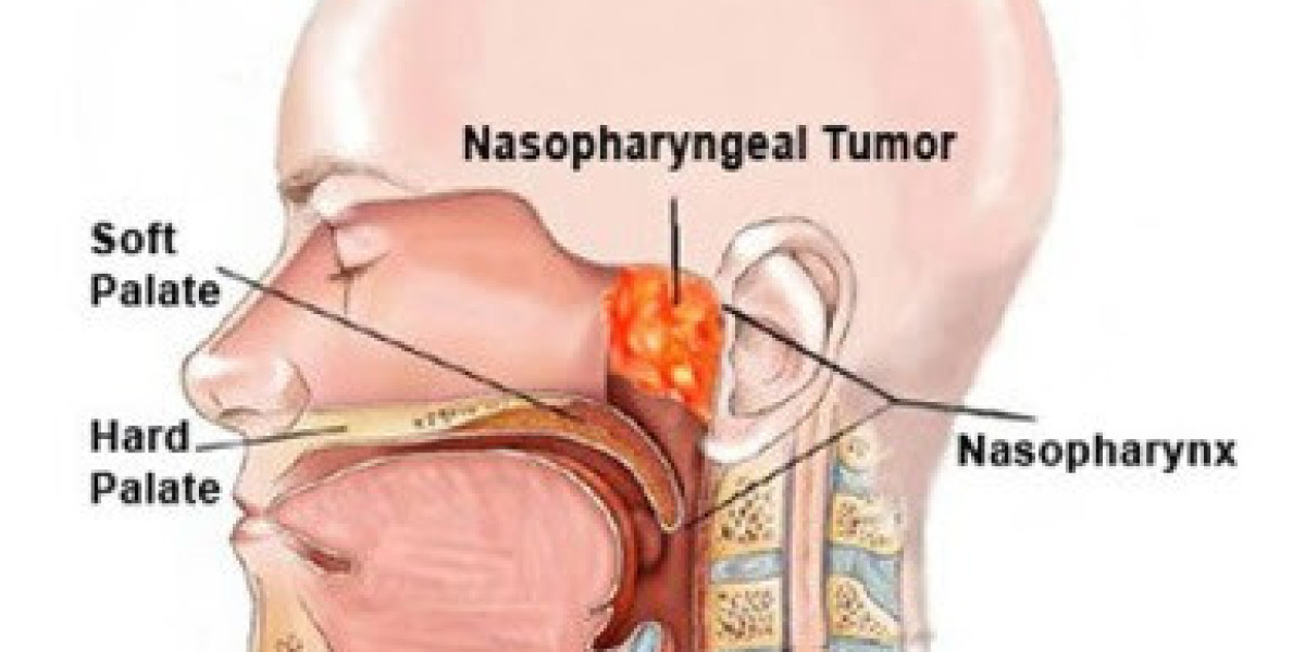 Nasopharyngeal Cancer Market Size, Share, Trends, Industry Report 2024-34