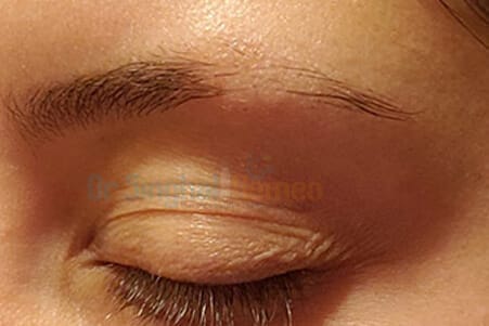 Homeopathy for Eyebrow Hair Loss Treatment: Safe & Effective