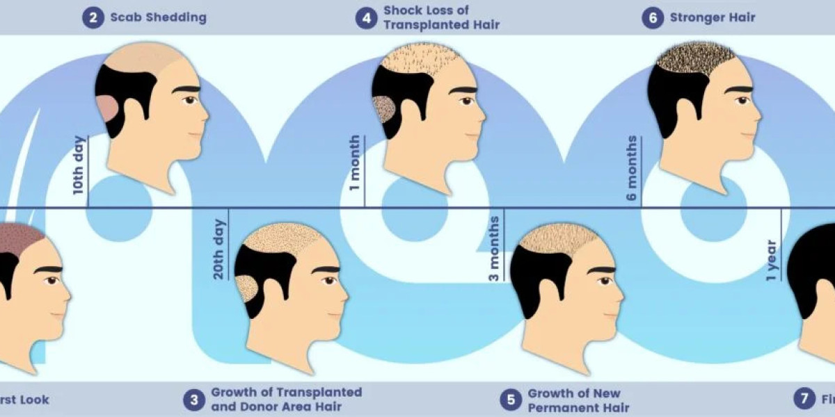 Hair Replacement in Turkey: Redefining Solutions for Hair Loss