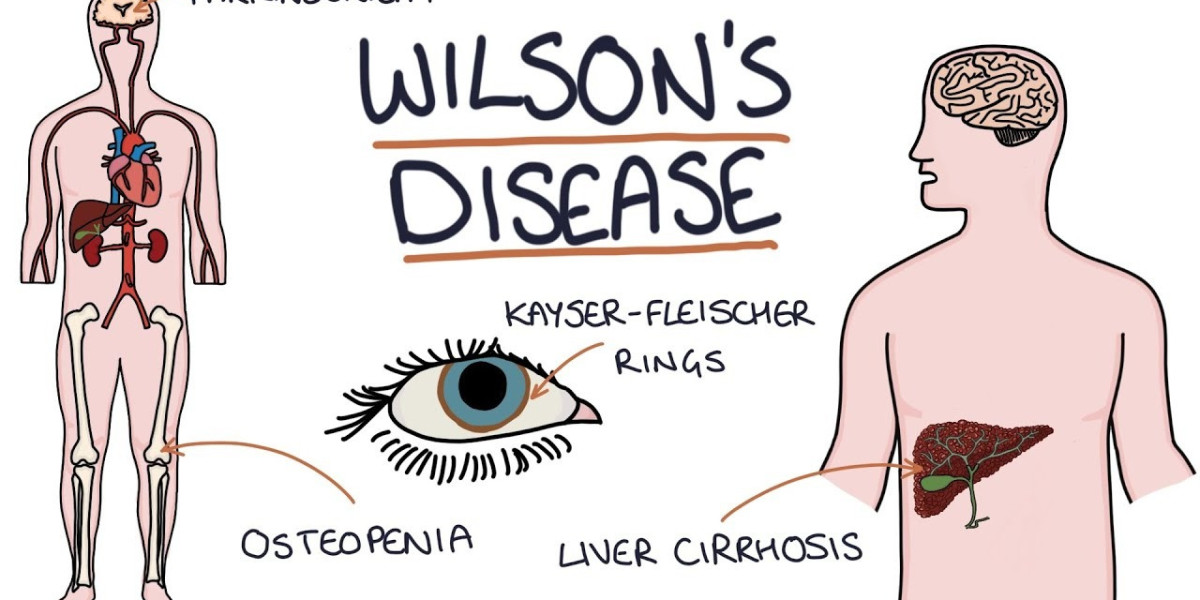 Wilson Disease Market Share Analysis, Growth, Report 2024-34