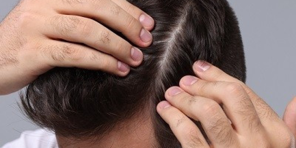 Hair Transplant in Islamabad: Cost, Procedure, and Recovery