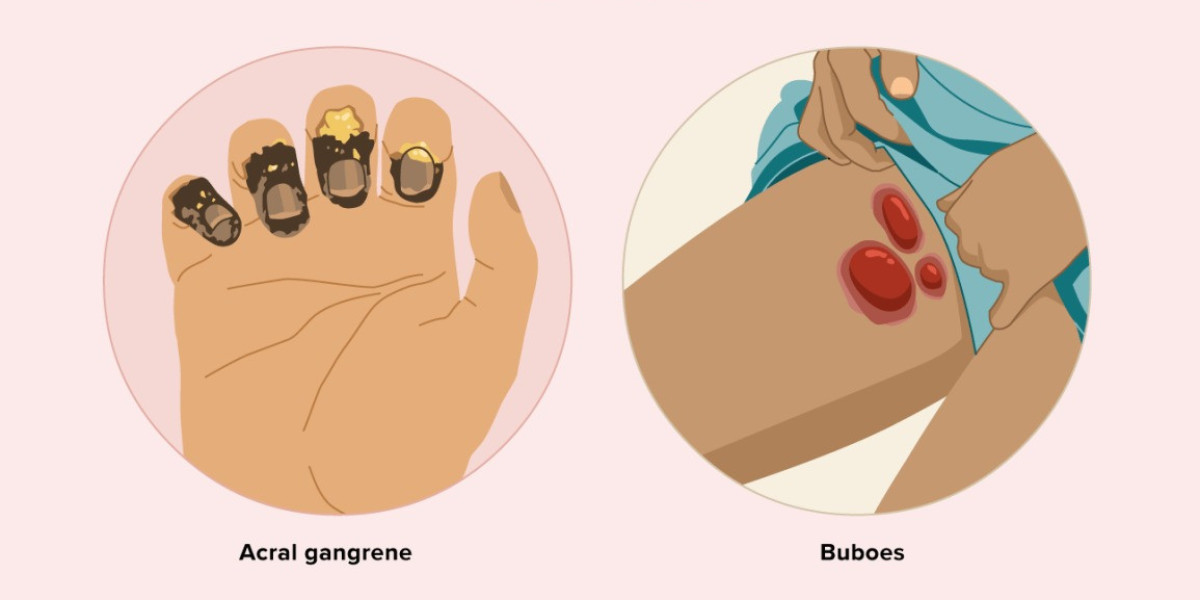 Plague Market Share, Industry Size, Growth, Forecast 2024-34