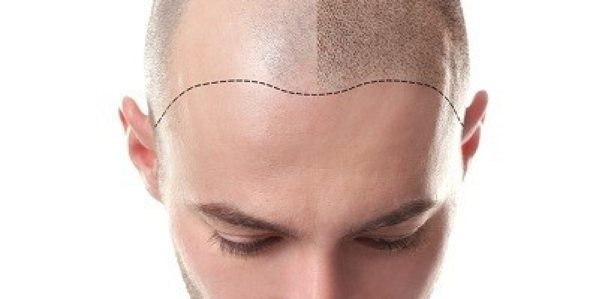 What Is the Age Limit for Hair Transplants in Islamabad?