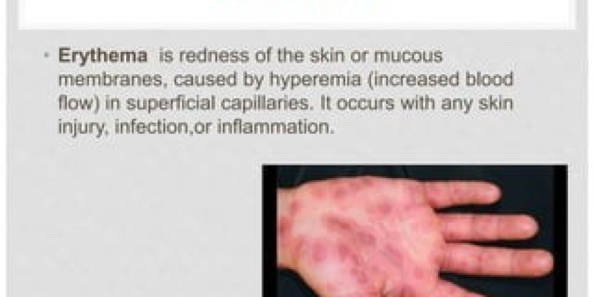 Erythema Market Trends Analysis, Growth, Report 2024-34