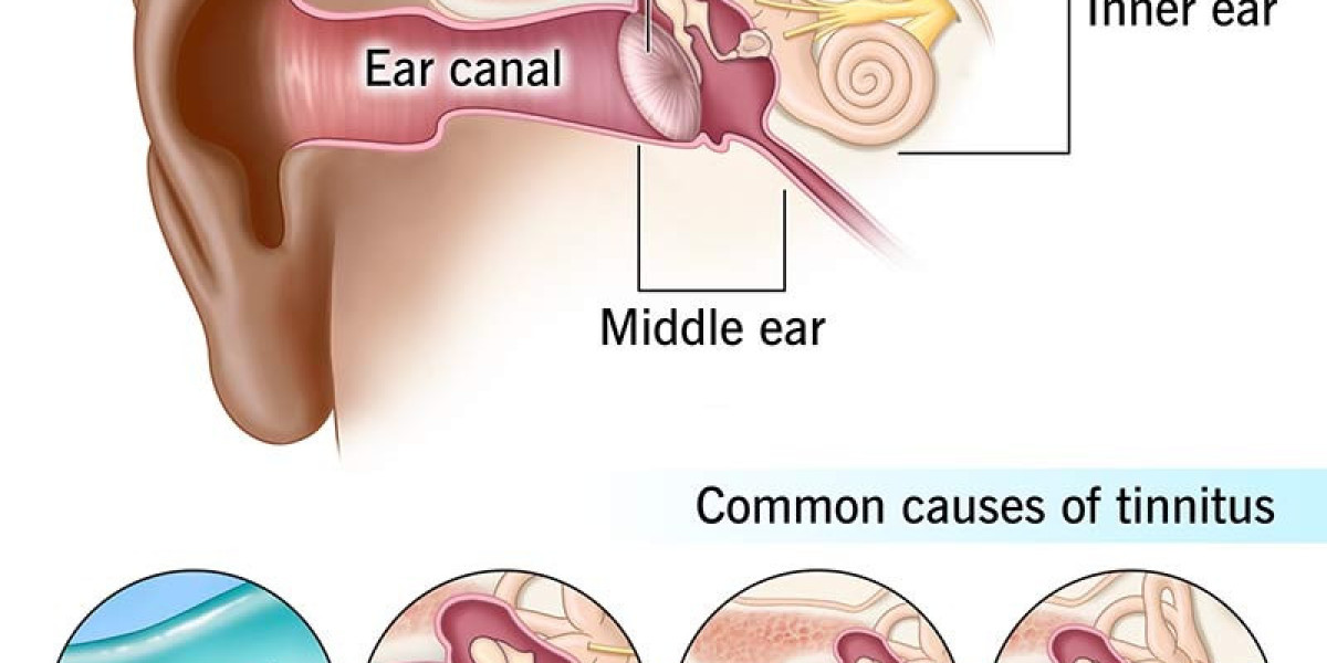 Tinnitus Market Size, Demand, Trends, Top Companies & Forecast - 2024-2034