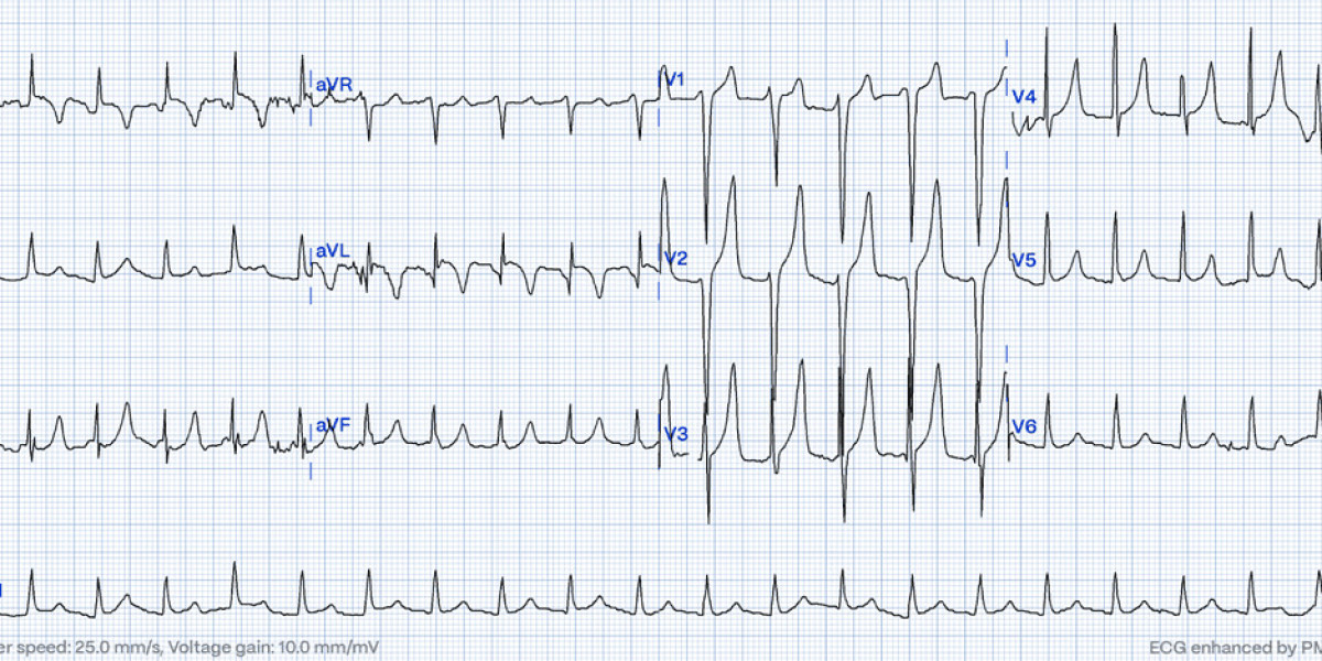 Hyperkalemia ECG Progression: Understanding the Critical Changes That Impact Diagnosis