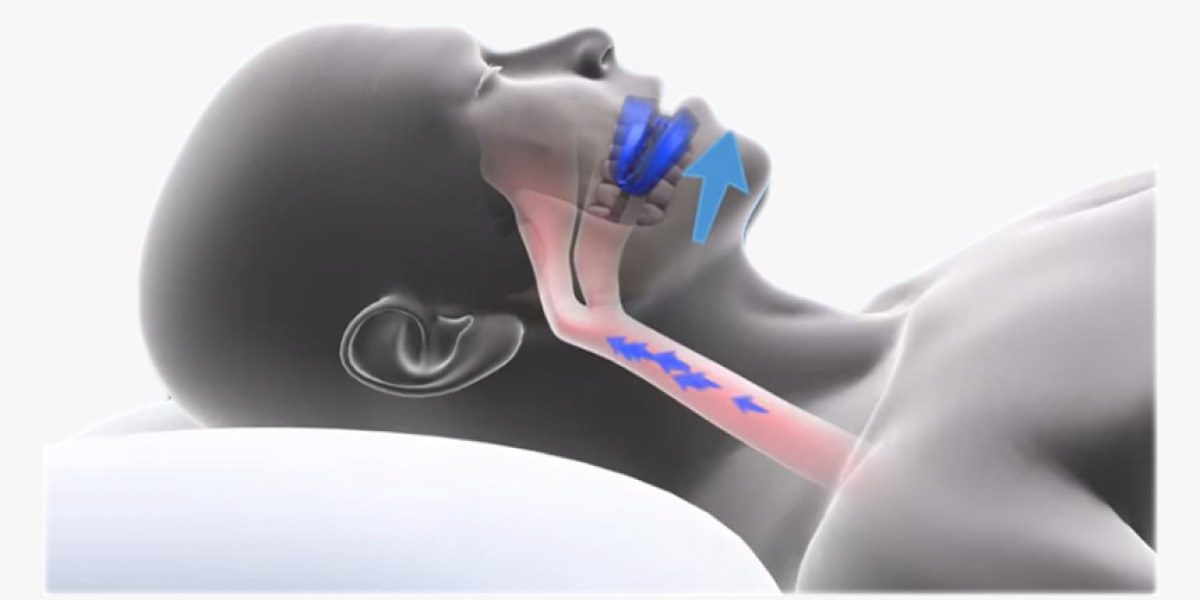 Anti Snoring Devices and Snoring Surgery Market Drivers Leading to Expanding Growth