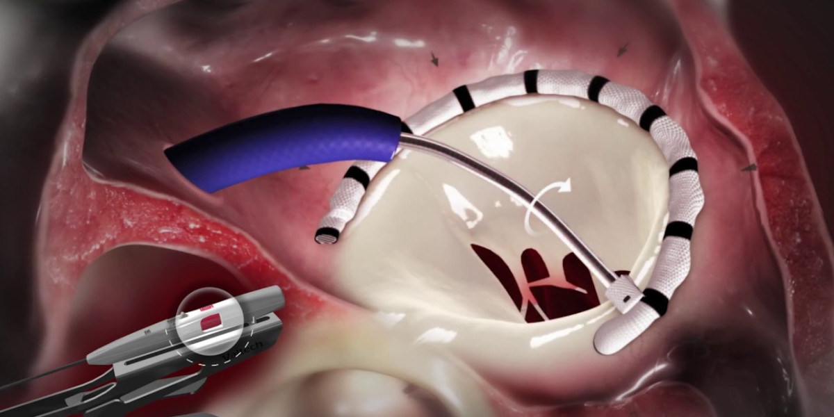 The Rise of Annuloplasty Rings Market: A Lifeline for Leaky Hearts