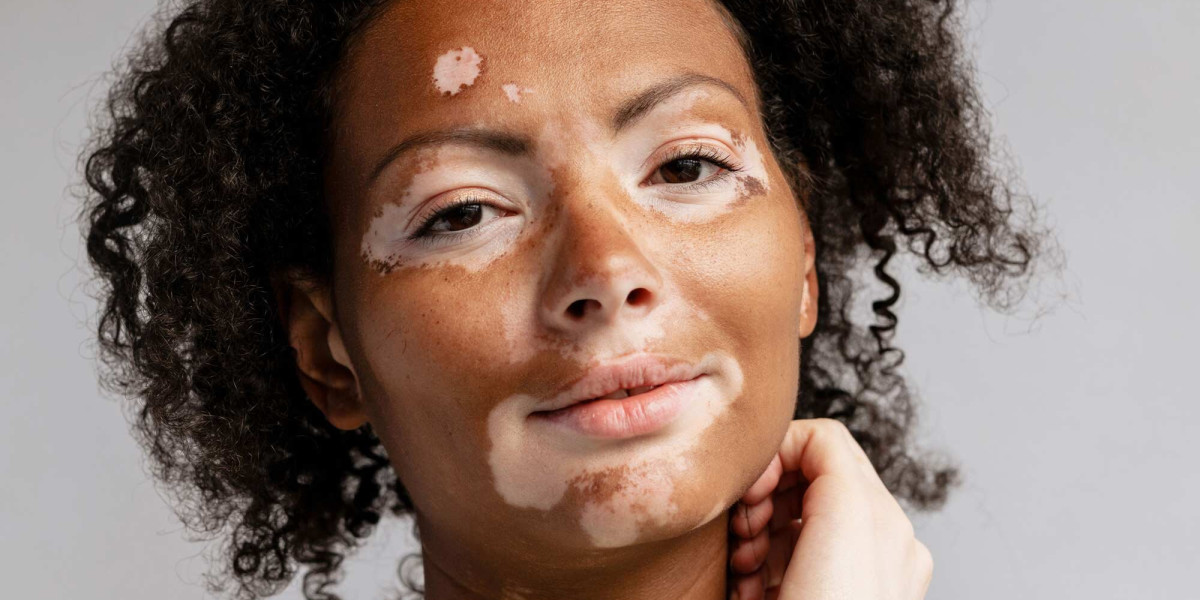 Pigmentation Disorder Treatment Market: Innovations & New Therapies 2025